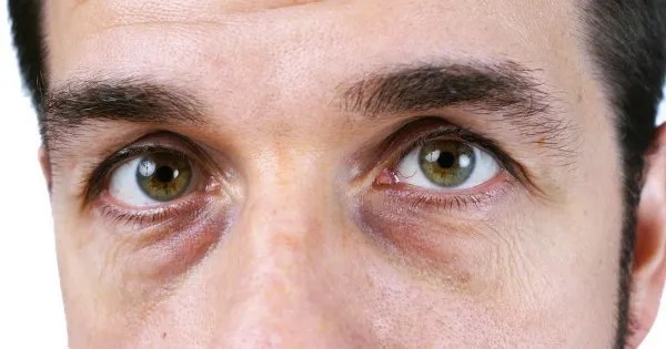 💫 Bolsas y ojeras: cómo tratarlas sin cirugía con Radiofrecuencia Fraccionada y Láser CO₂