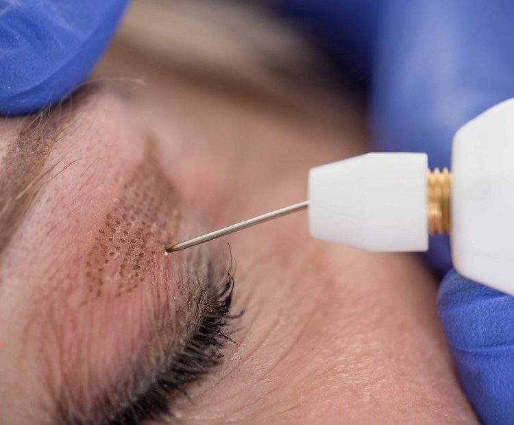 Plasma Pen en frente y párpado superior: diferencias entre piel fina y piel gruesa