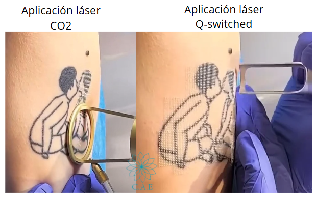 «Desvanece Tu Pasado: Láser CO2 + Q-Switched para Eliminación de Tatuajes»