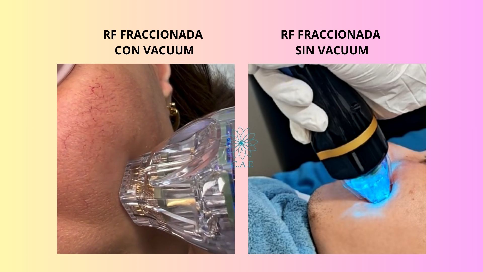 Diferencias entre RF Fraccionadas