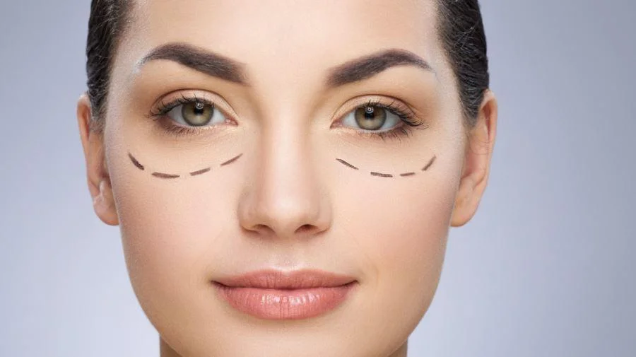 ¿Bolsas en los ojos resistentes? Por qué el Plasma Pen falló y la tecnología que realmente redefine la mirada